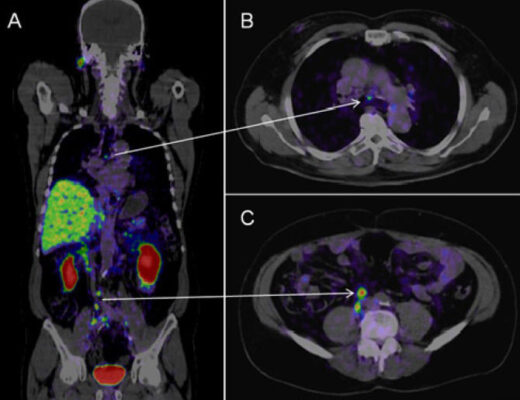 pet ct scan