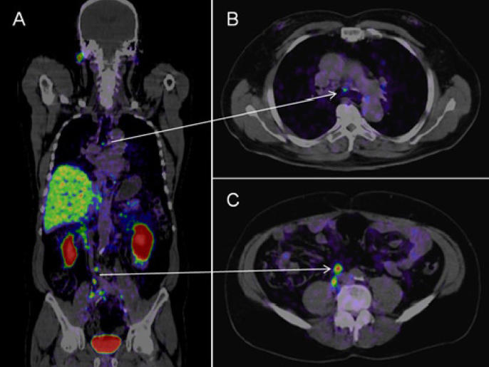 Does A Pet Scan Show All Cancers