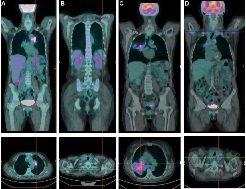 pet ct scan