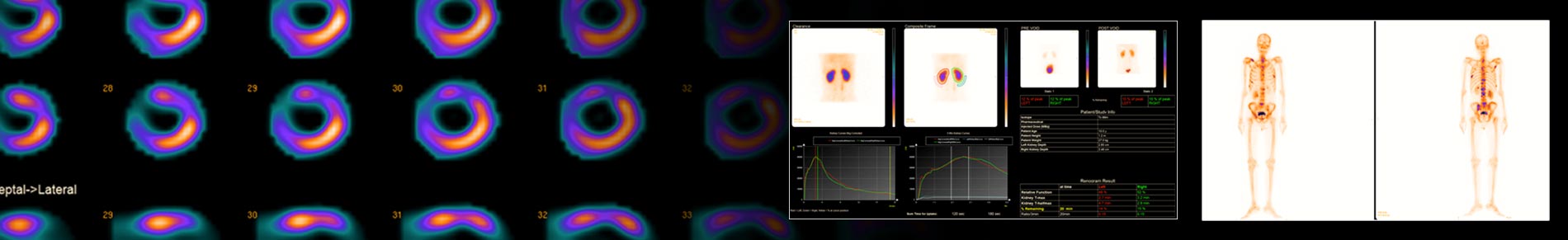 Gamma Camera Scan in Rohtak