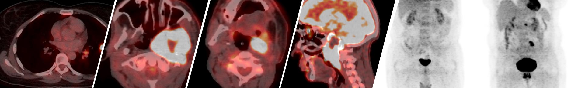 PET CT Scans