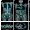 PET CT Scan for Cancer Treatment